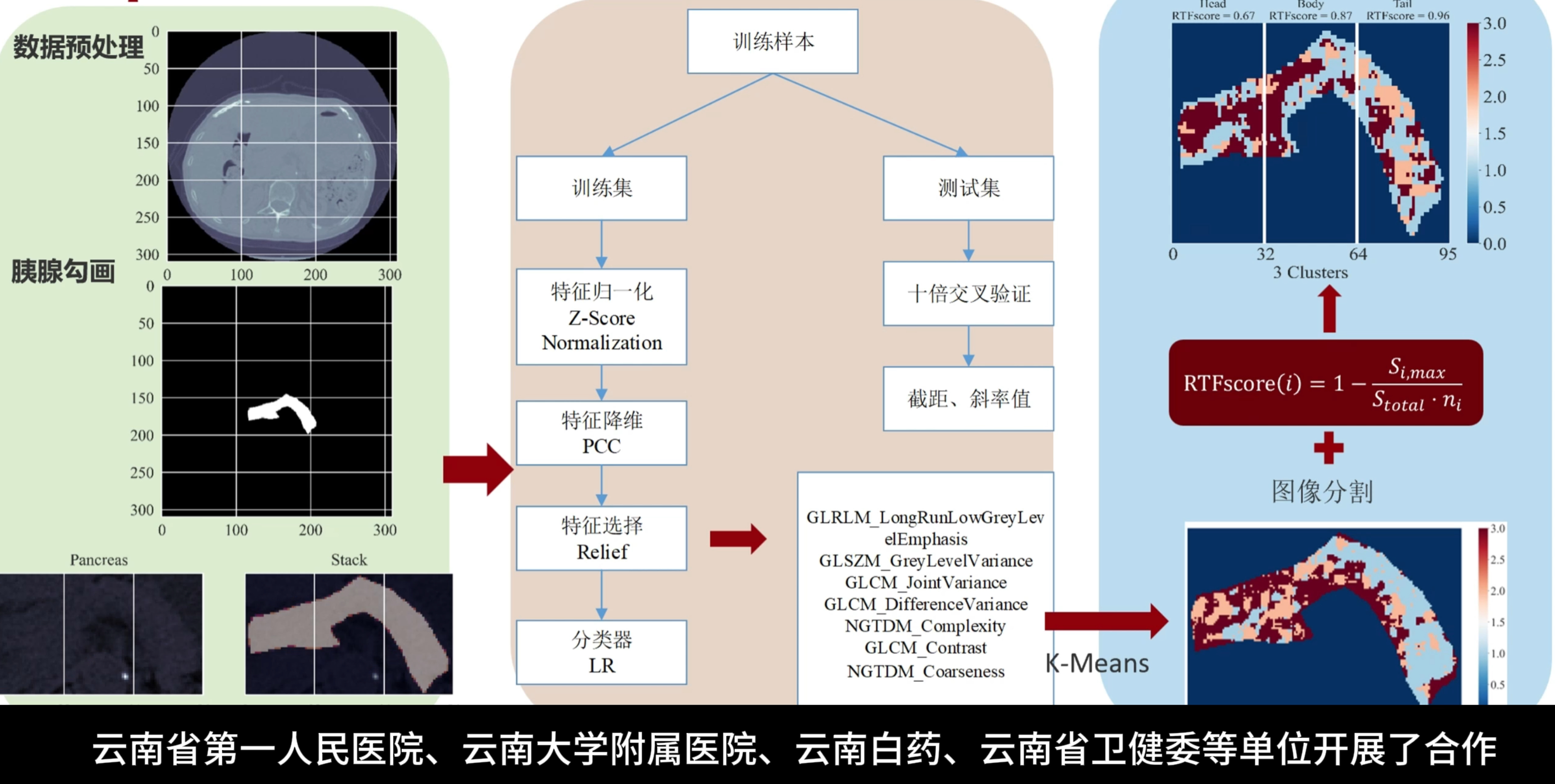 糖尿病胰腺CT影像的病灶区域精准识别
